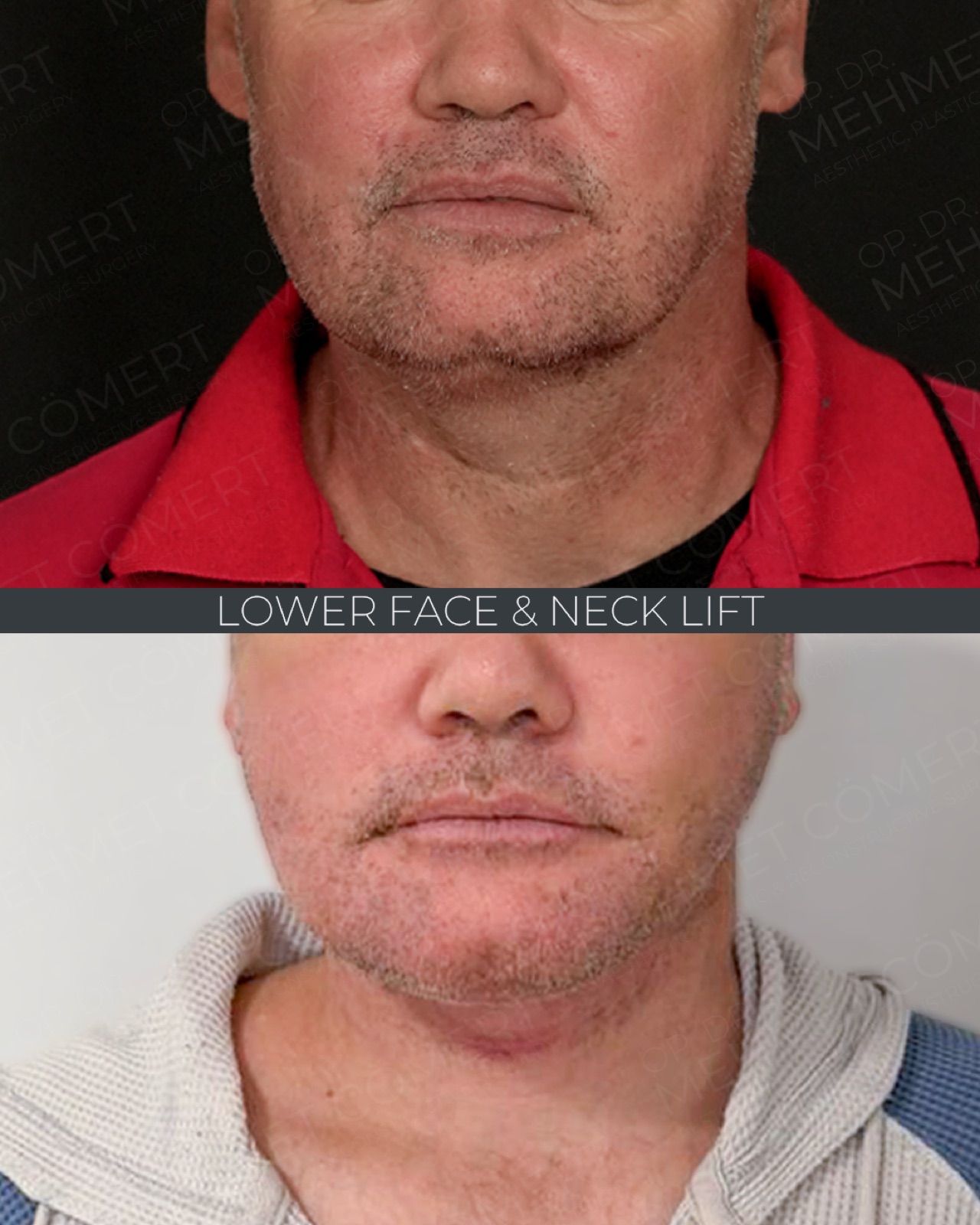 Deep Neck Lift — before and after