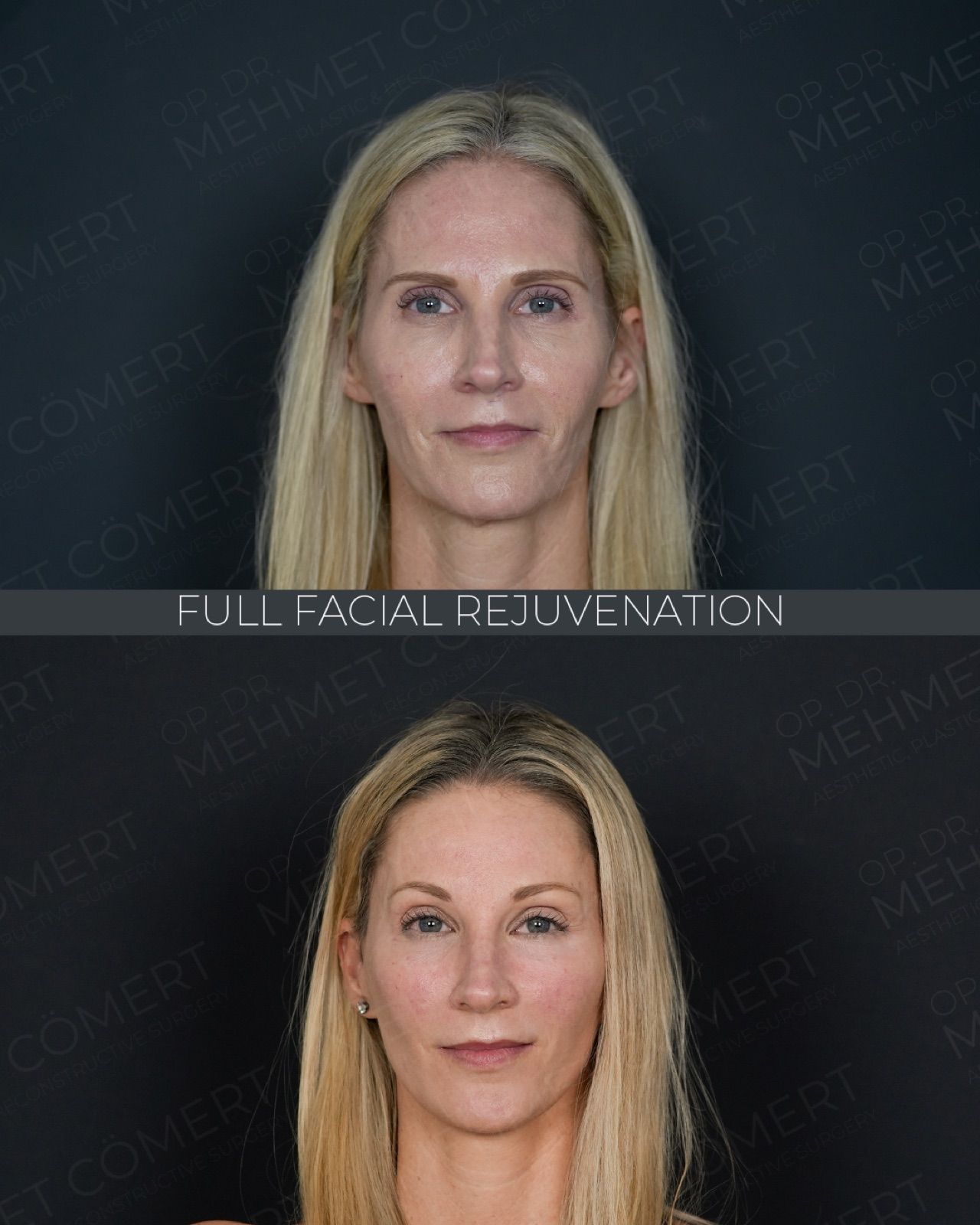 Deep Plane Facelift — before and after