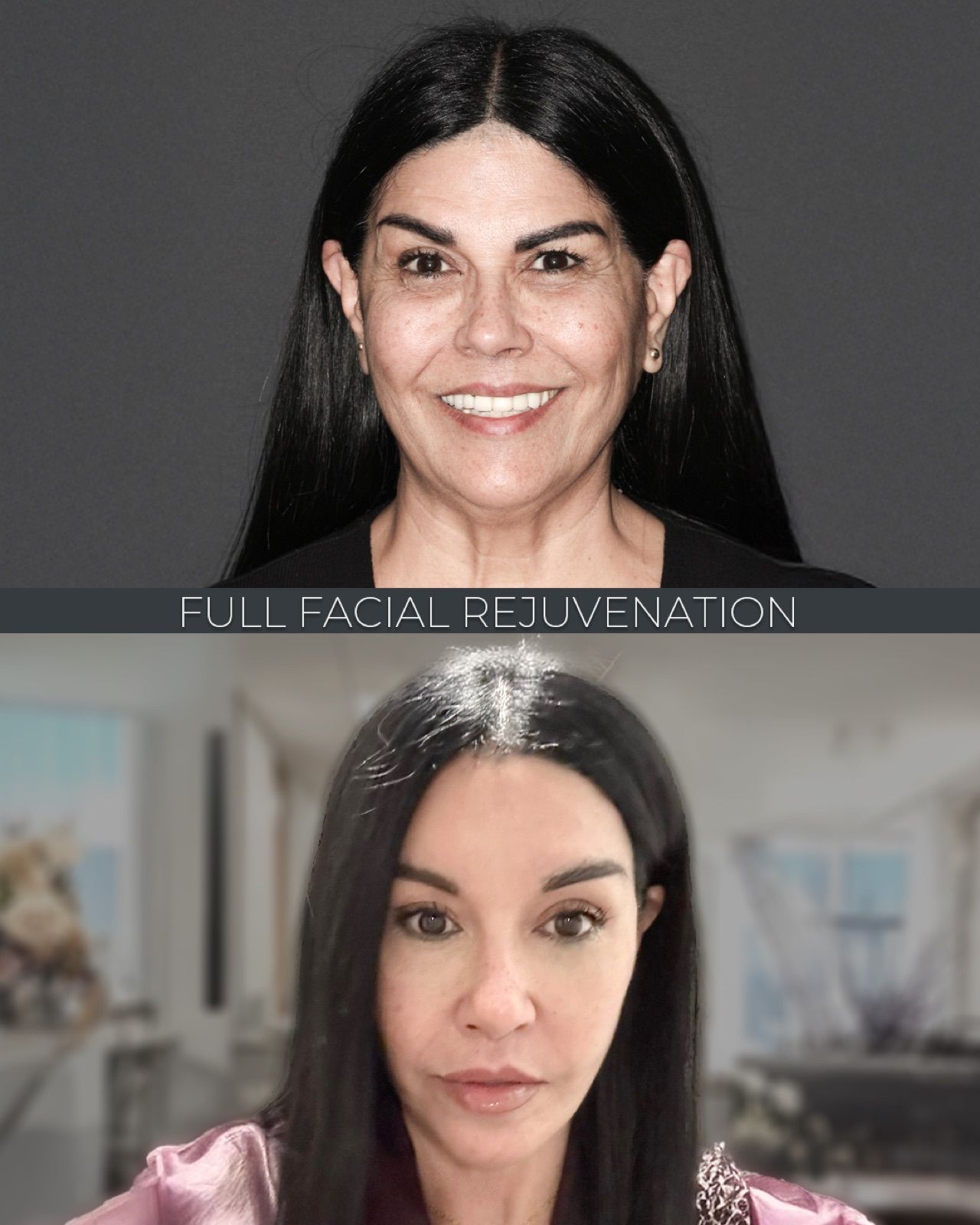 Revision Deep Plane Facelift — before and after