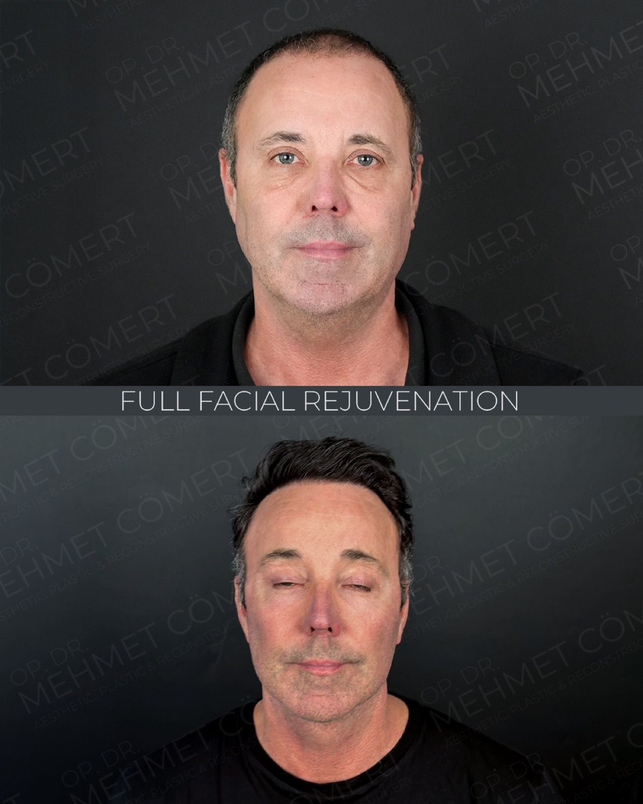 Deep Plane Facelift — before and after