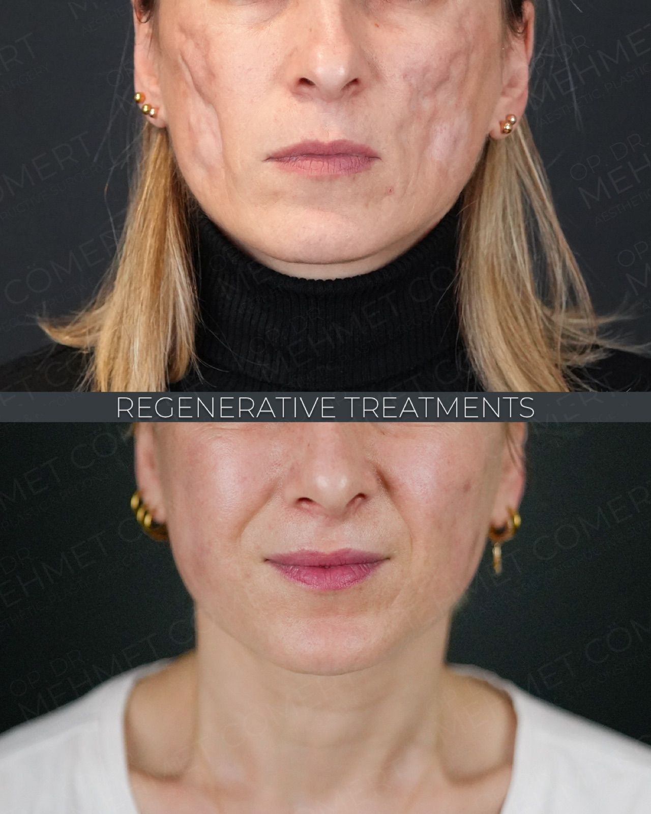 Fat, Nano-Fat & Micro-Fat Grafting — before and after