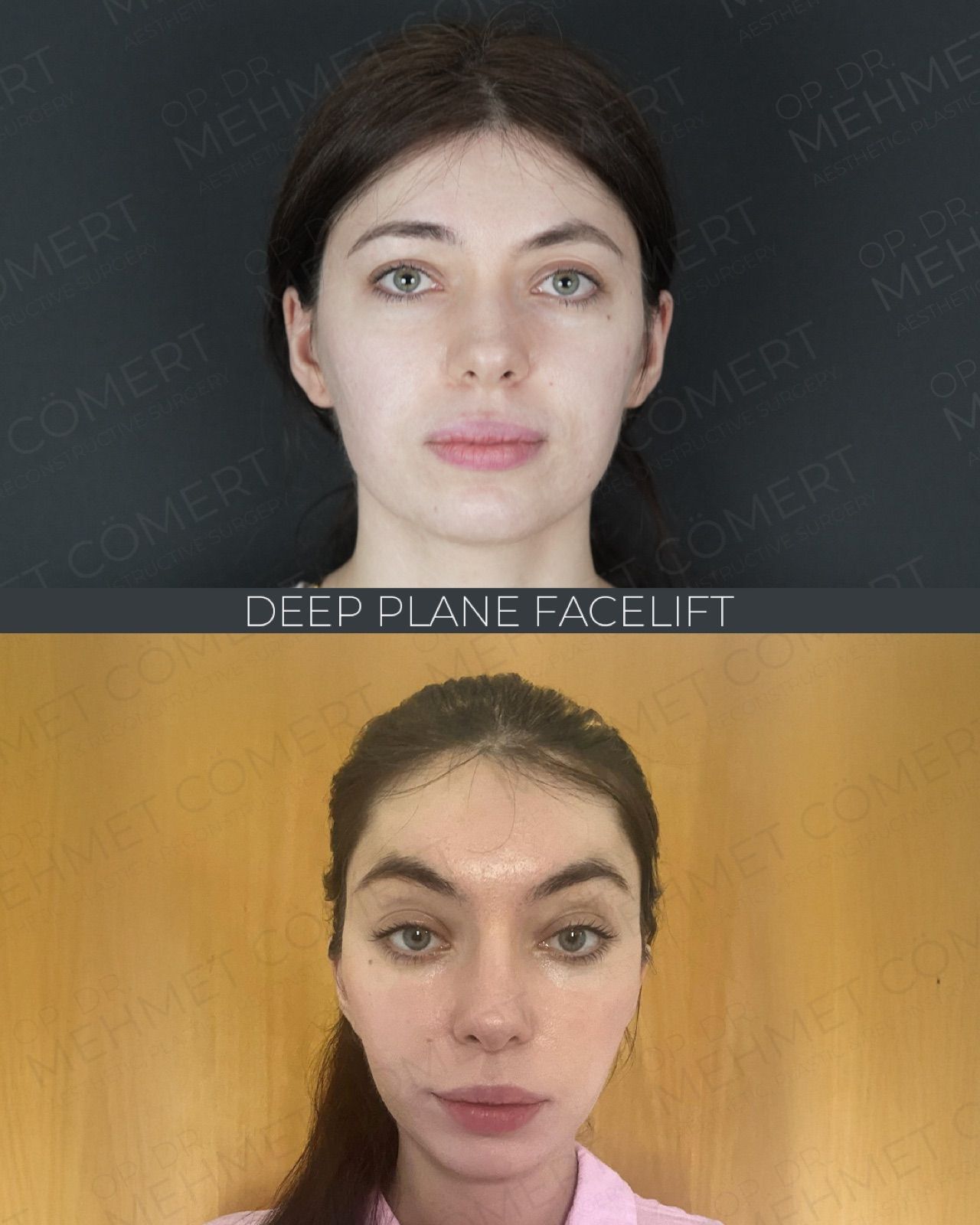 Deep Plane Facelift — before and after