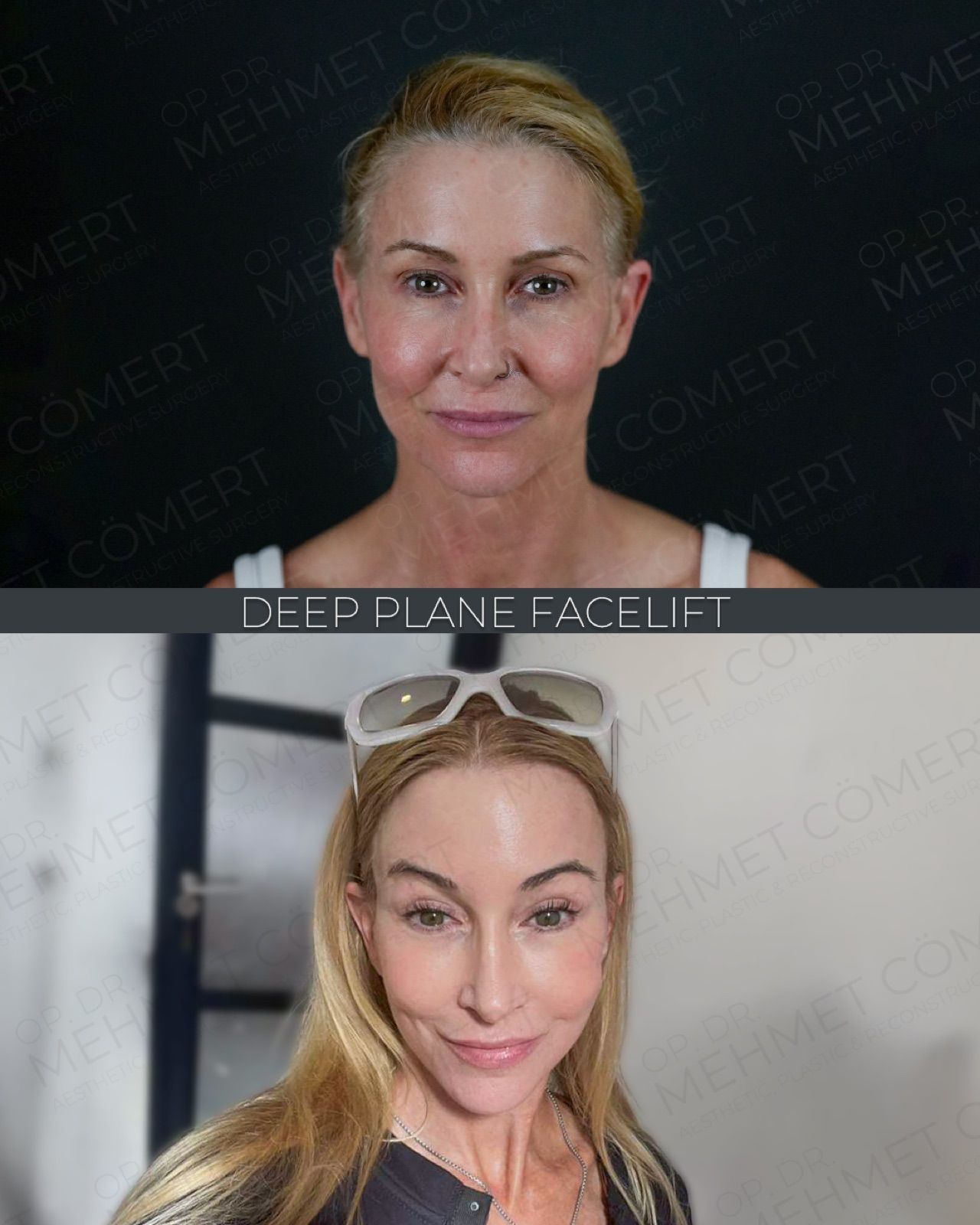 Deep Plane Facelift — before and after