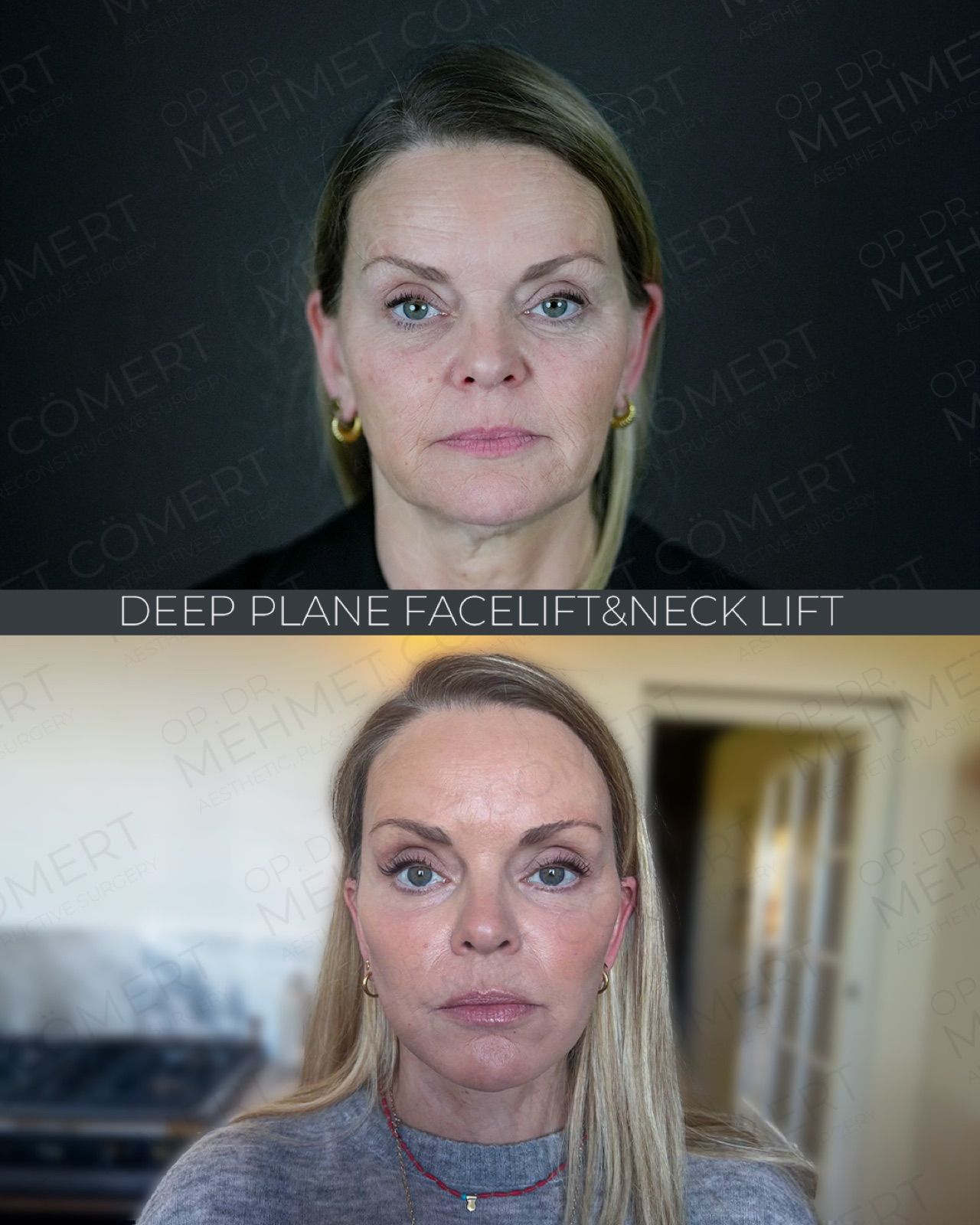 Deep Plane Facelift — before and after