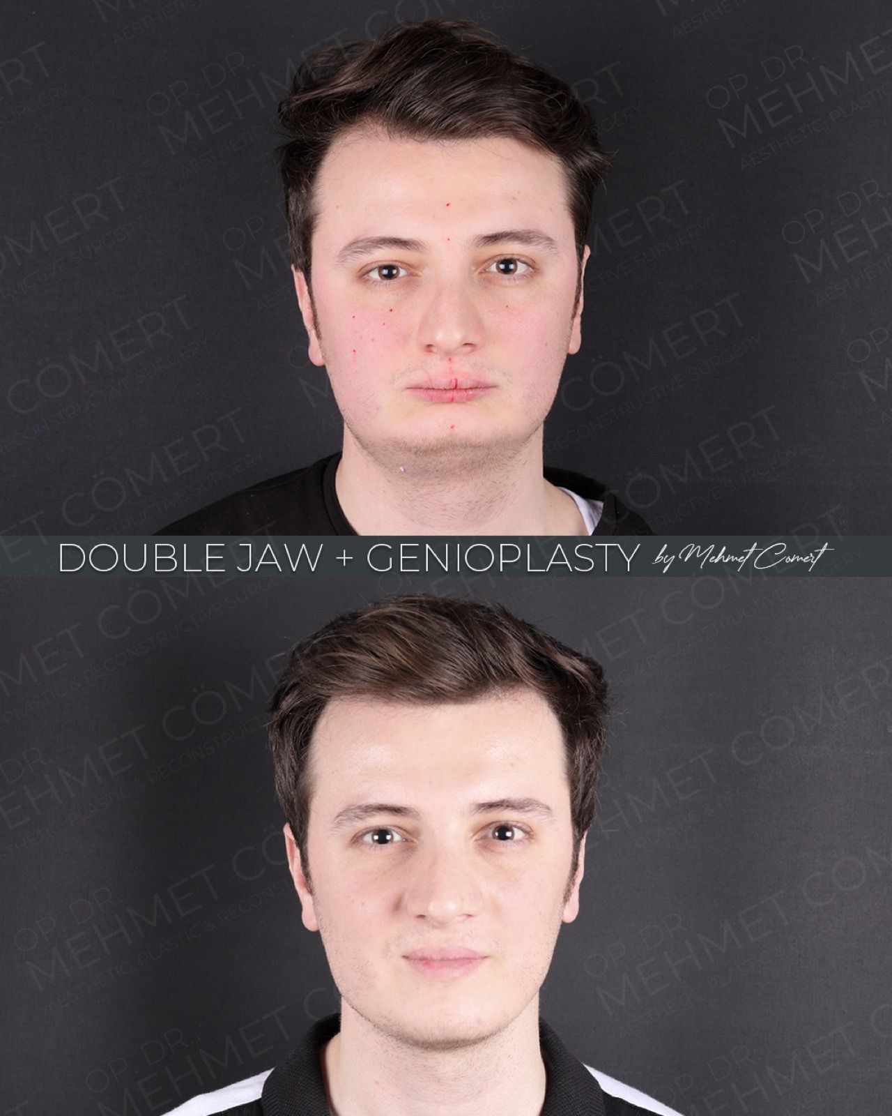 Double Jaw — before and after