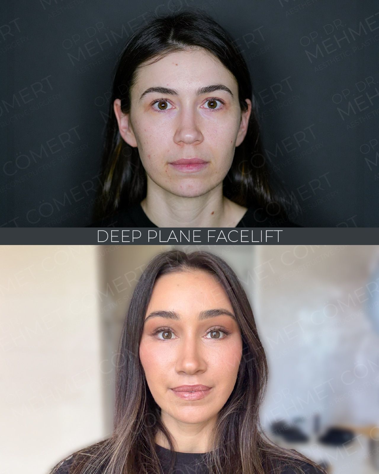 Endoscopic Facelift — before and after