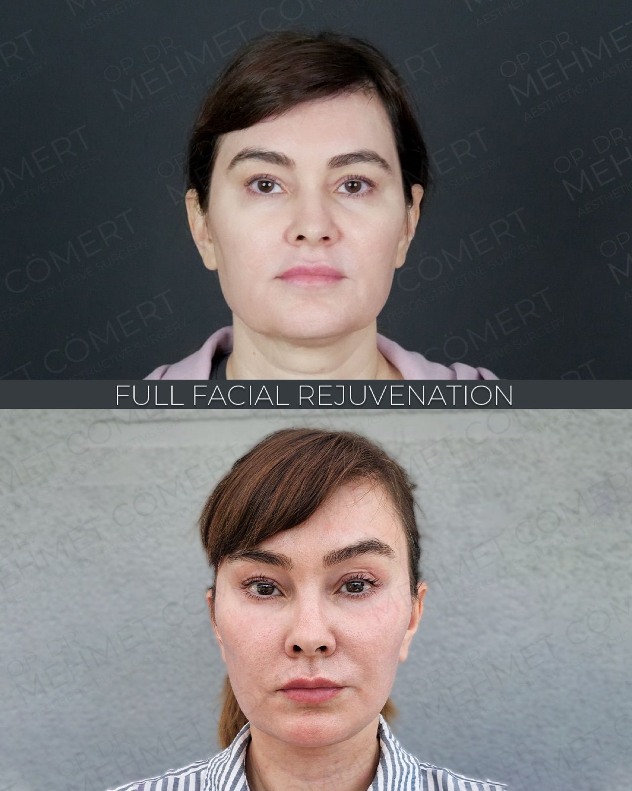 Deep Plane Facelift — before and after