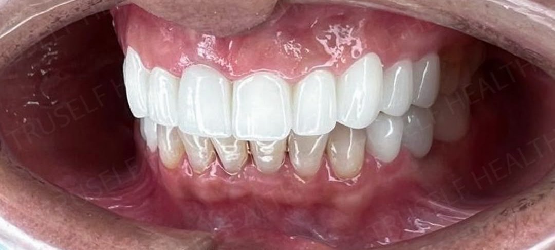 Hollywood smile veneers in Turkey