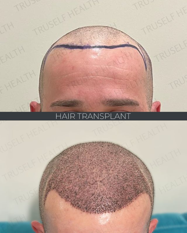 Hair Transplant — Sapphire FUE — before and after