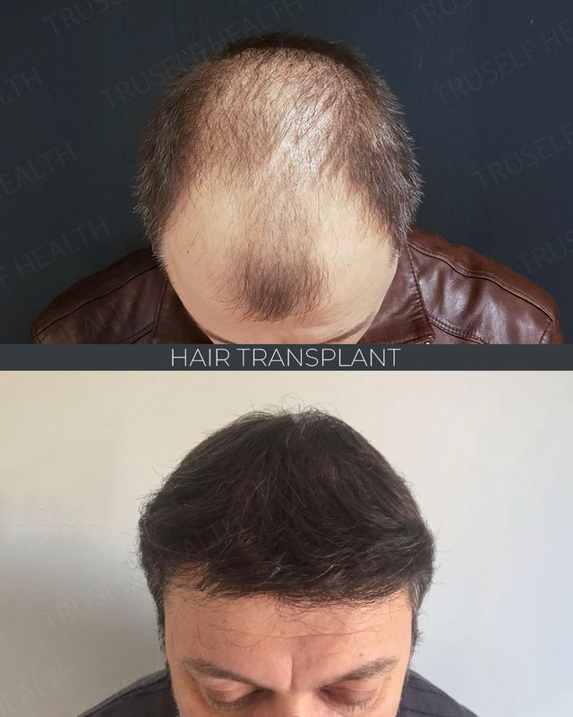 Hair Transplant — DHI — before and after