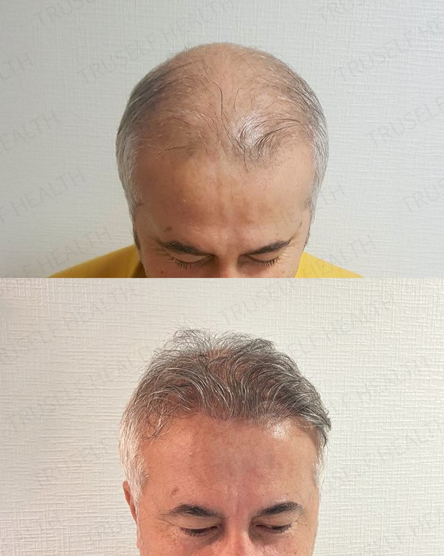 Hair Transplant — Sapphire FUE — before and after