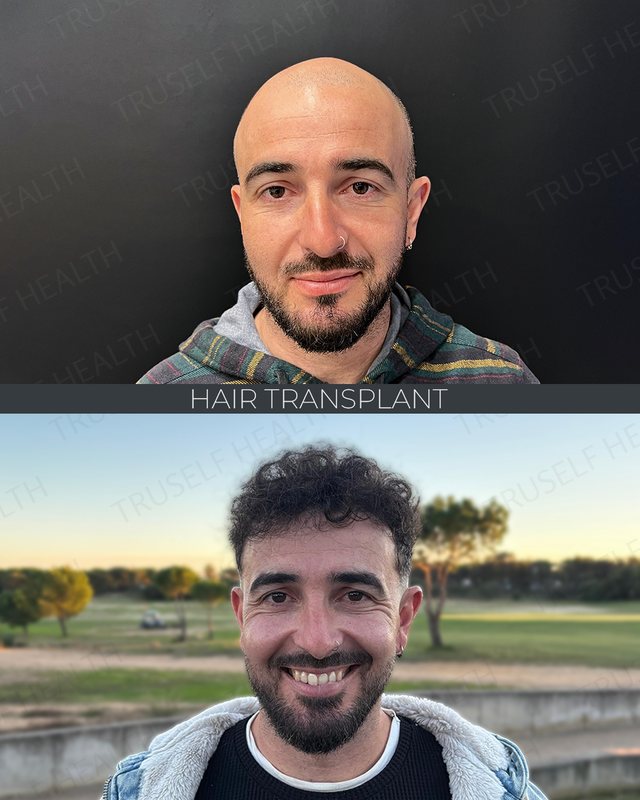 Hair Transplant — FUE — before and after